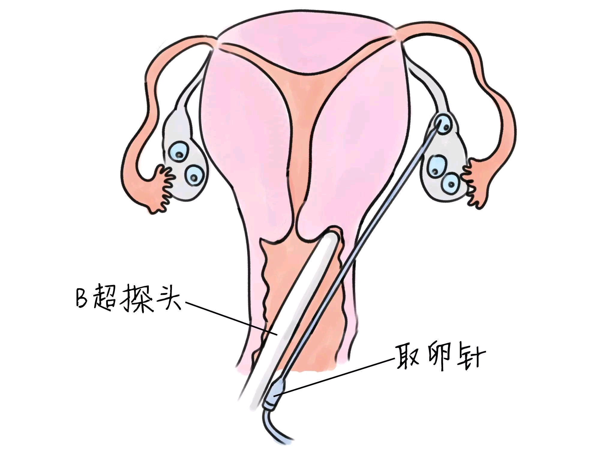 移植早孕试纸