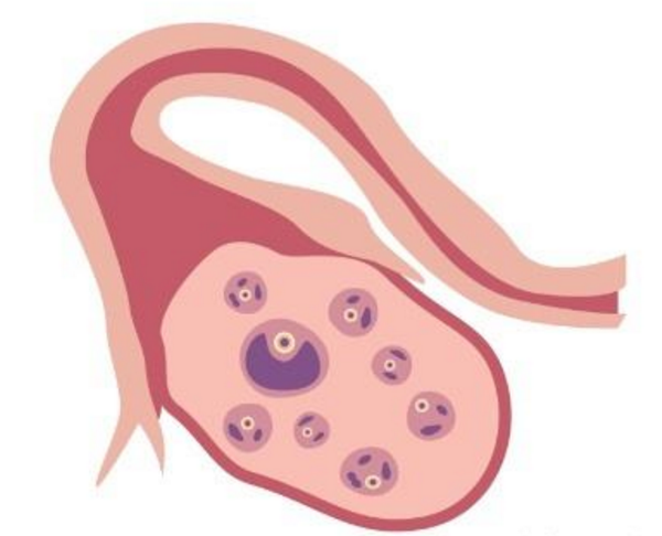 穿刺怀孕